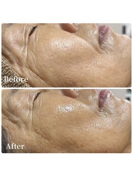 エース(ACE.)/ハーブピーリング施術1回の変化