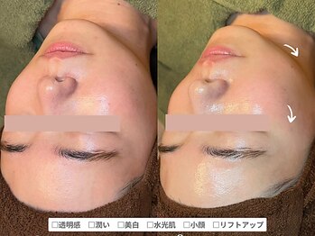 アンシャンテ 神戸元町店(Enchante)/毛穴洗浄ピーリングフェイシャル