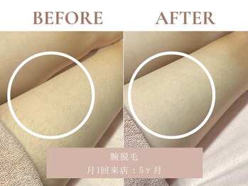 サエラ(SAERA)/脚脱毛【5回】