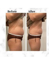 ザビューティー 麻布十番本店(The Beauty)/12Dリフトお腹美くびれ[リフト]