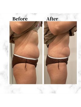 ザビューティー 麻布十番本店(The Beauty)/12Dリフトお腹美くびれ[リフト]