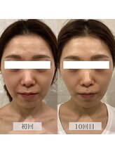 ラバ 名古屋栄店(LAVA)/小顔コルギ【丸顔・ほうれい線】