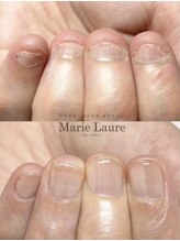 マリーロール 天王寺店(Marie Laure)/自爪育成/深爪矯正/ネイルケア