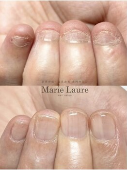 マリーロール 天王寺店(Marie Laure)/自爪育成/深爪矯正/ネイルケア