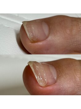 リリ(lili)/巻き爪矯正2回目(左親指)