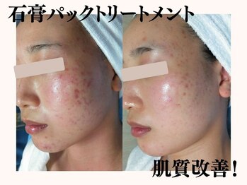 りりあす/こじらせる前に早めにお手入れ!