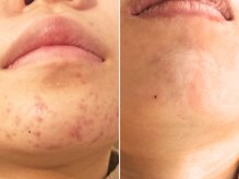 ハダイ(HADAY)/ニキビ改善｜ハーブピーリング