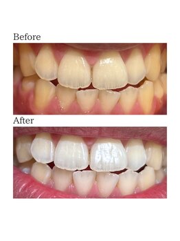ノーブル 上土店(Noble)/ホワイトニングBeforeAfter