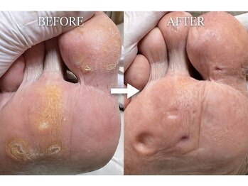 巻き爪補正店 金山店/魚の目・タコ（施術前と施術後）