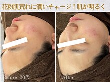 ぷるる 練馬 江古田/20代　ララピール＋ゲルマスク