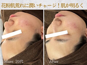 ぷるる 練馬 江古田/20代 ララピール+ゲルマスク