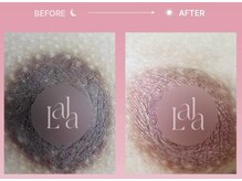 シャリテ(Charite)/ララピンク　乳輪ケア