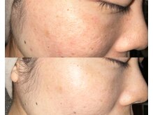 ル シーニュ/プロセルフェイシャル(5回目)