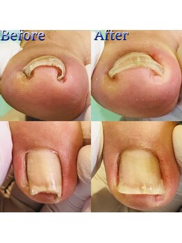 巻き爪補正店 湘南辻堂店/巻き爪・補正例