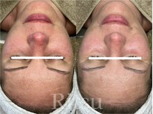 リツ(Ritsu)/敏感/日焼け後ケア