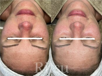 リツ(Ritsu)/敏感/日焼け後ケア