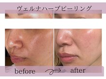 サロンドボーテアリス (Salon de beaute ALICE)の雰囲気（大人気のヴェルナハーブピーリングは一度で効果を実感！）