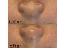 バイカラー(BY COLOR)/ハイドラ毛穴洗浄