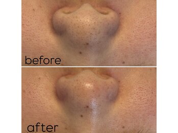 バイカラー(BY COLOR)/毛穴洗浄