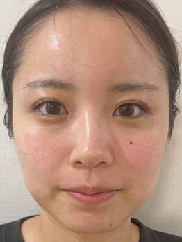 小顔になりたい