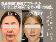 真皮育成　光糸リフトのビフォーアフター