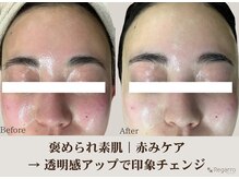 レガロビューティクリエイションズ桜川店の雰囲気(根本から整え肌トラブルを繰り返さない、人気施術です♪)