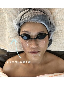 アルページュ(Arpege)/半顔に照射でギュッとリフト！