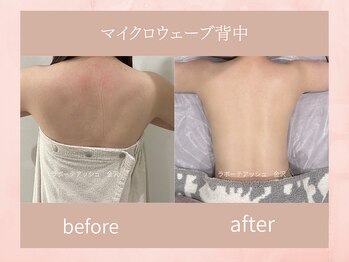 ラボーテアッシュ(La beaute H)/マイクロウェーブ背中
