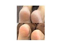 ココ(Coco)の雰囲気（かかと角質ケア）