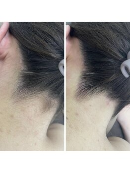 カルディエ(Cardie)/パーツ脱毛