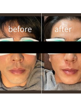 モンド(Mondo)/メンズ脱毛【ヒゲ】