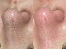 ヴィーヴ 京橋(vive)/【韓国式3D毛穴洗浄】