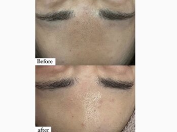 アワピール 成田公津の杜店(AWA PEELL)/ハーブピーリングで毛穴レス