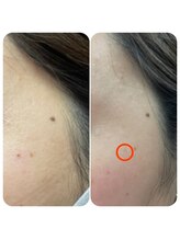 ル シェノン(Le Chainon)/シミケア*長年のお悩みもお任せ!