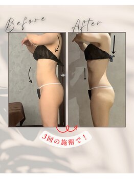 リンガ(Ringa)/ビフォーアフター【腸活ケア】