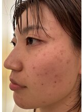 ラシェプリズ(LACHER PRISE)/施術経過（30代）