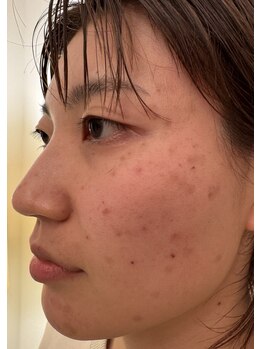 ラシェプリズ(LACHER PRISE)/施術経過（30代）