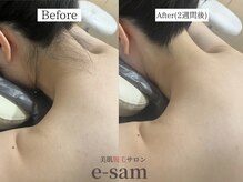 イーサム 高槻摂津富田店(e-sam)/丸ごと全身脱毛