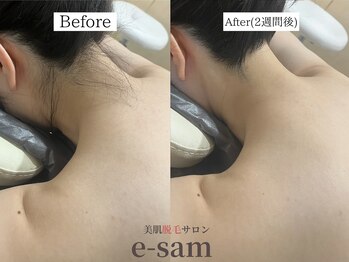 イーサム 高槻摂津富田店(e-sam)/丸ごと全身脱毛