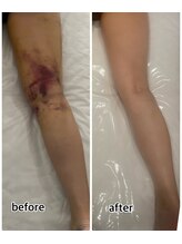 インディバジェム(GEM)/ビフォーアフター