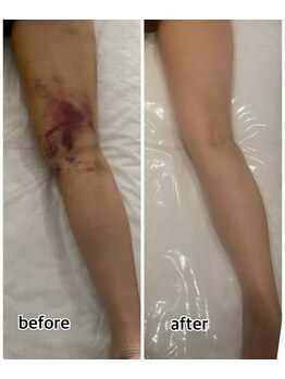 インディバジェム(GEM)/ビフォーアフター