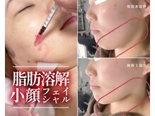 ルポ 鶴見(Repos)/【プラズマ×小顔脂肪分解】1回