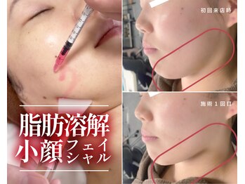 ルポ 鶴見(Repos)/【プラズマ×小顔脂肪分解】1回
