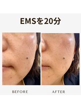 プレジール(plaisir)/たるみ改善しませんか？7