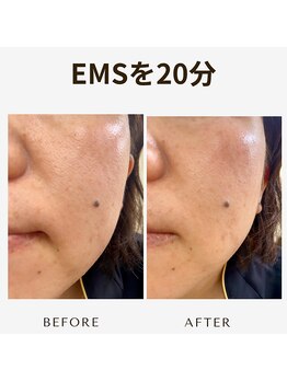 プレジール(plaisir)/たるみ改善しませんか？7