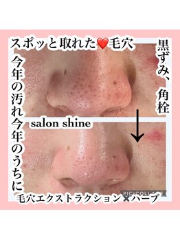 サロンシャイン(Salon Shine)/毛穴エクストラクションプロ