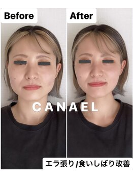 カナエル(CANAEL)/ボトッ.クスなしエラ張り改善