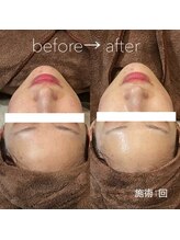 フォルチェ 春日(Folche)/美白フェイシャル