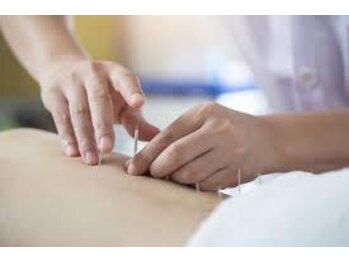 新越谷駅前鍼灸整骨院/鍼は、急な痛みや頑固な痛みに◎