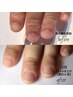 ※男性専用※ 継続中2回目以降【深爪矯正コース】¥13.200
